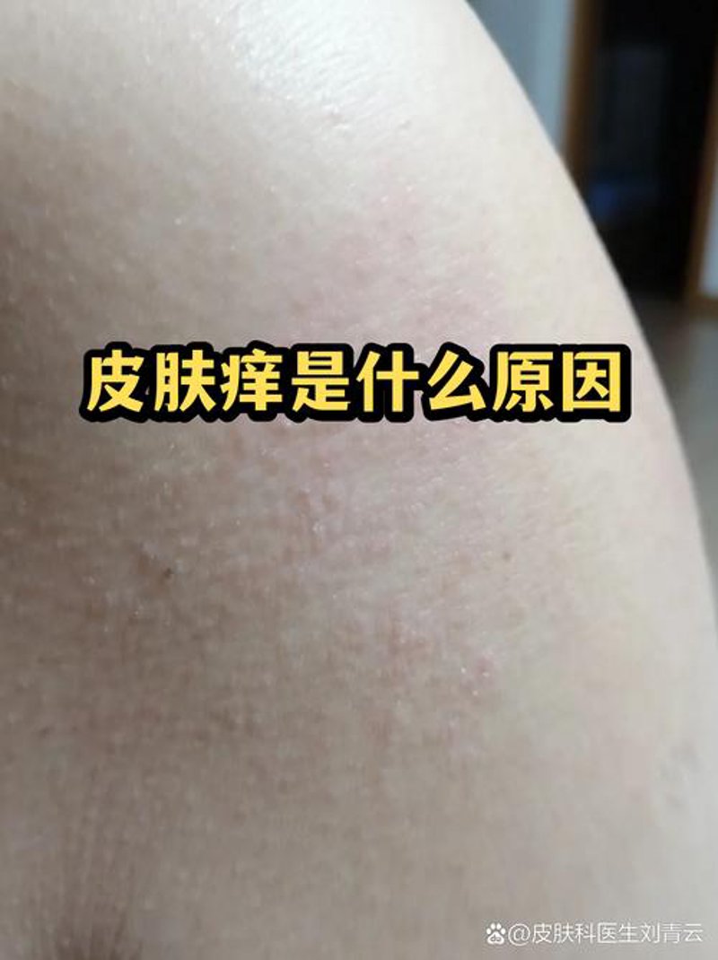 荨麻疹：常见问答