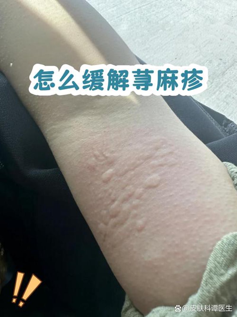 湿疹治疗趋势解读：从传统到现代的转变