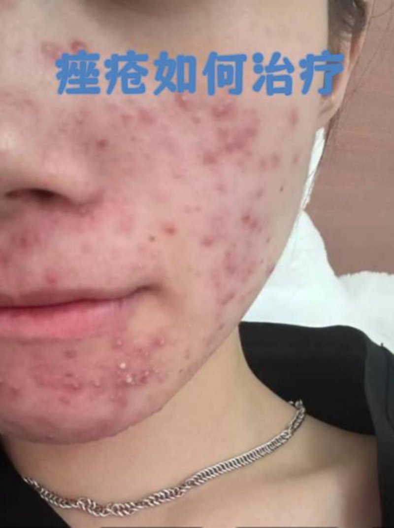 济南皮肤病医院的精准治疗案例分享